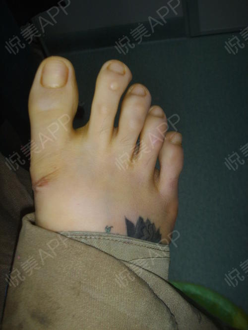患者,女,24岁,来自湖南邵阳,由于双足的大拇趾外翻样畸形