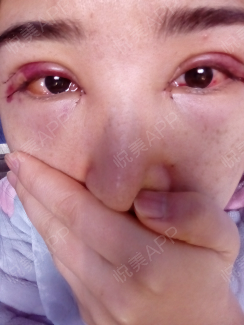 开了外眼角,所以眼结膜有点儿发炎,瘀血消了一些.右.双眼皮_悦美整形