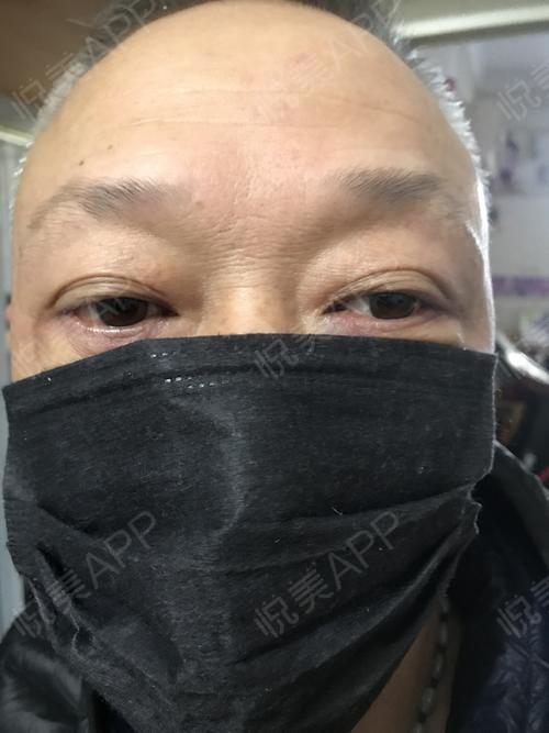 关注我关注我恢复的怎么样了恢复的非常非常好就像天生没有长过眼袋一