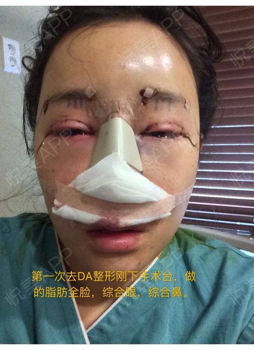 在韩国DA整形做的手术,眼睛,脂肪填充,鼻子三