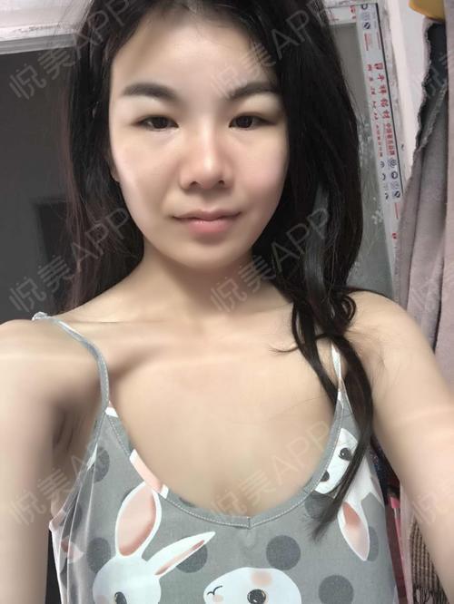 假体隆胸术后32天_隆胸术后32天_胸部术后32天_飞公子分享图片5