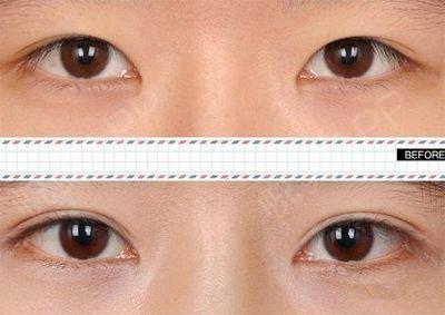 平行or扇形双眼皮,你的双眼皮形状真的选对了吗?