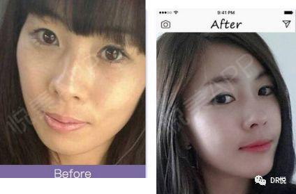 韩国人公认的整容脸,特征果然是面填过度呀