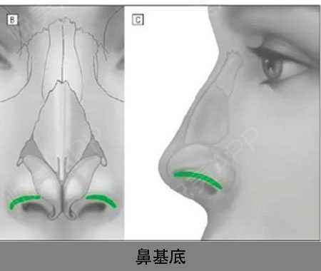 填充鼻基底一般可以用注射填充,假体填充,自体软骨填充三种方式.