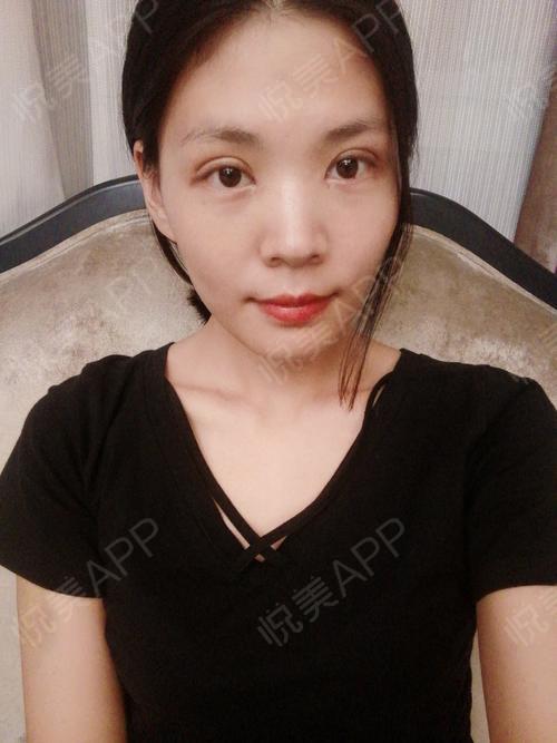 后9天_开眼角术后9天_双眼皮术后9天_眼部术后9天_梦洁丫丫分享图片7