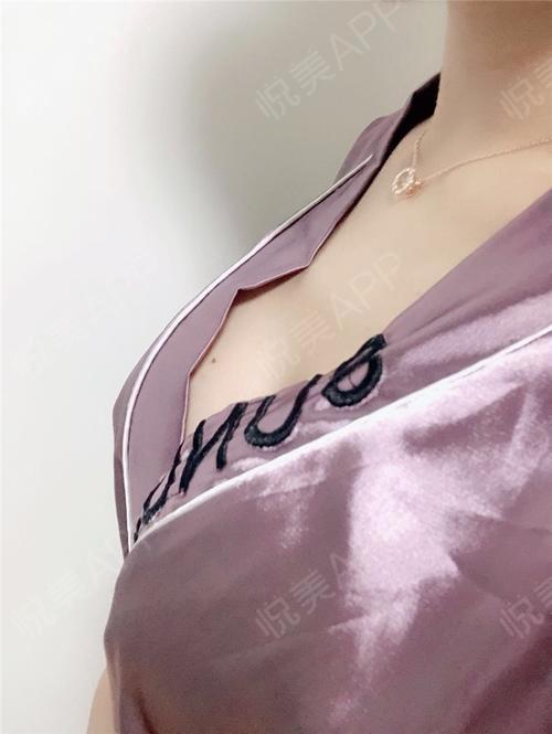 乳房下垂矫正术后90天_假体隆胸术后90天_胸型美化