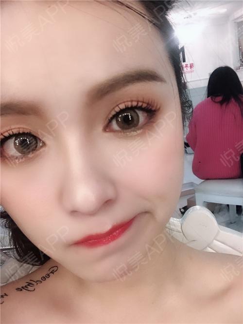 【爱美尔眼综合术后90天】嗨各位小仙女们,今天我在做