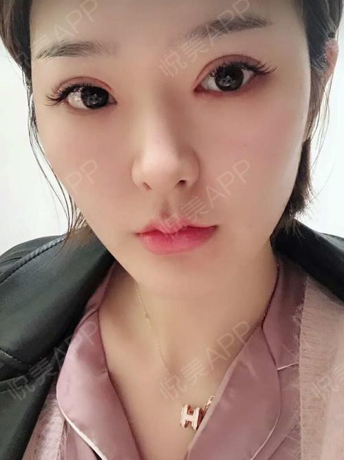 人中缩短术后21天_玻尿酸术后21天_面部轮廓术后21天_口唇整形术后21