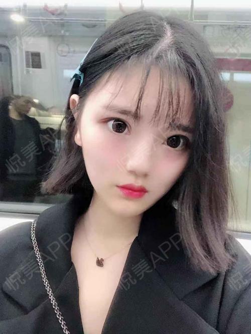 整形术后66天_双眼皮术后66天_眼部术后66天_泡泡龙的小仙女分享图片9