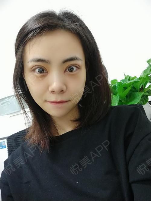 失败修复术后15天_开眼角术后15天_双眼皮术后15天_眼部术后15天_刘