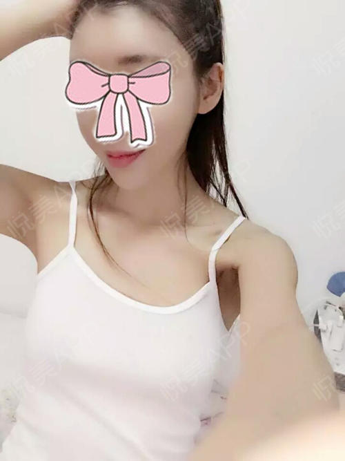 乳晕缩小术后2天_乳头缩小术后2天_乳头内陷矫正术后2天_乳头/乳晕