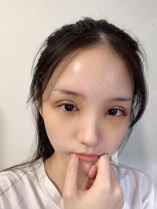 术后5天_开眼角术后5天_双眼皮术后5天_眼部术后5天_阿娴cc分享图片4