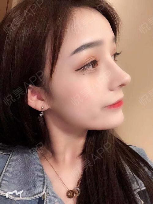 鼻综合整形术后45天_自体肋软骨隆鼻术后45天_鼻综合术后45天_隆鼻术