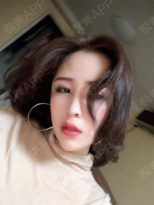 鼻综合整形术后32天_自体肋软骨隆鼻术后32天_硅胶假体隆鼻术后32天