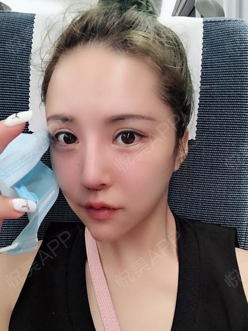 人中缩短术术后1天_m唇手术术后1天_唇型美化术后1天_人中缩短术后1天