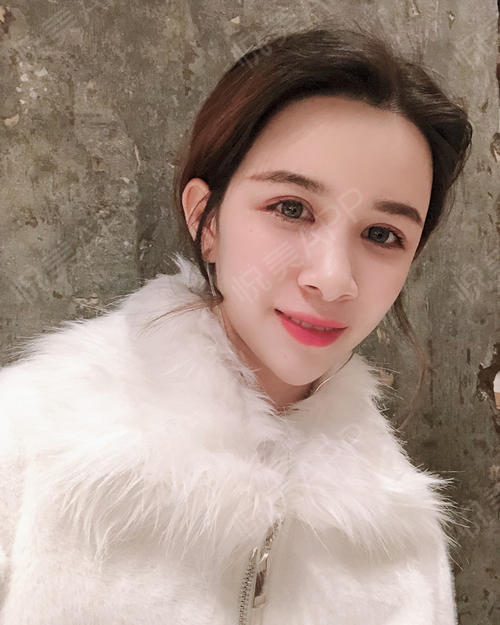 术后38天_自体脂肪术后38天_面部轮廓术后38天_小耳朵minmin分享图片3