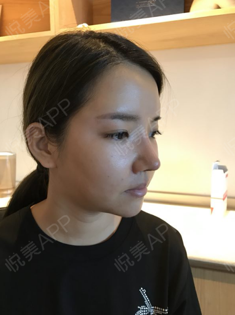 在上海喜美做了半肋鼻综合和垫鼻基底今天已经过了一个礼拜了拆完线