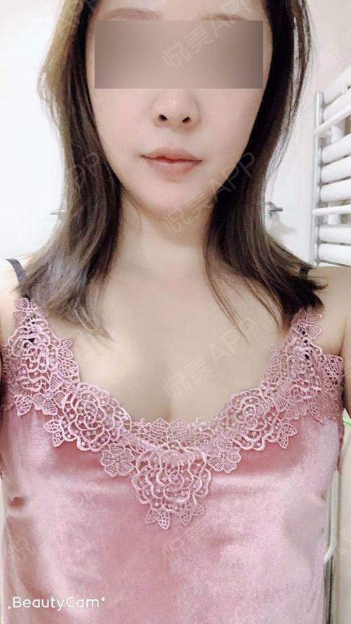 隆胸失败修复术后10天_乳房下垂矫正术后10天_自体