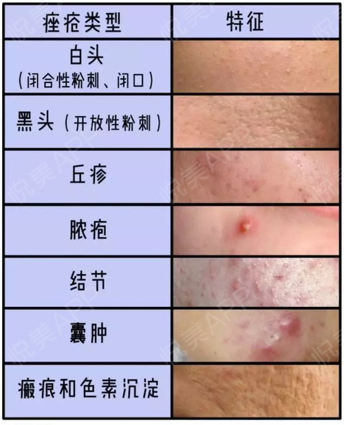 形成角栓粉刺;在封闭的环境中,毛囊中的微生物尤其是痤疮丙酸杆菌大量