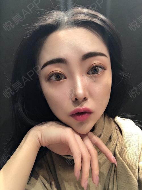 鼻综合整形术后121天_硅胶假体隆鼻术后121天_鼻综合术后121天_隆鼻术