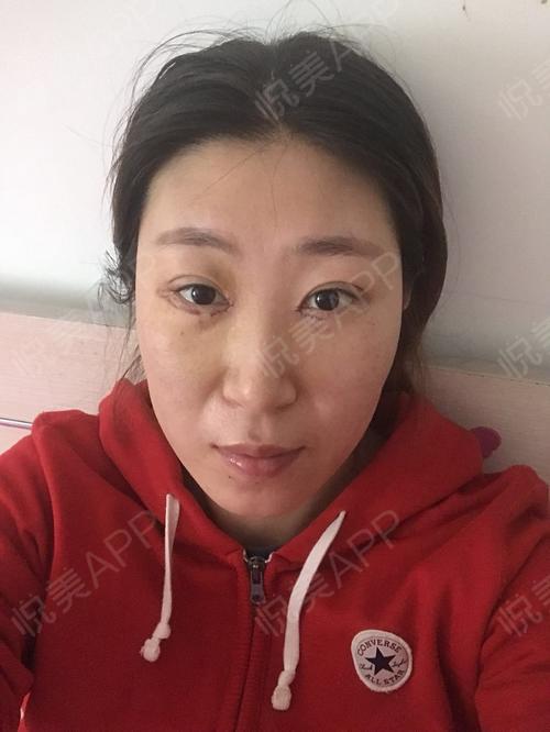 激光去眼袋术后5天_去眼袋术后5天_眼部术后5天_我遇见对的人分享图片